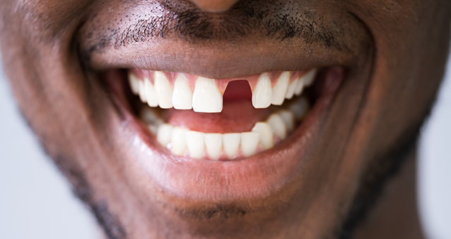 Smiling man with missing front tooth