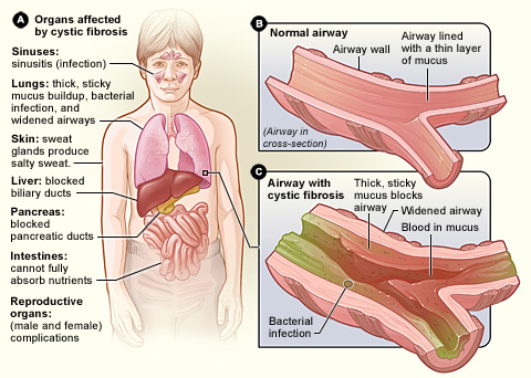 Cystic Fibrosis (CF) 